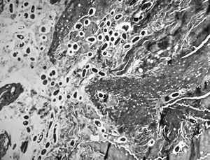 M,57y. | dermatomycosis